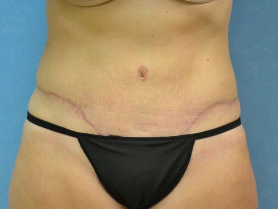 Tummy Tuck: Case 1811- Lyons, OH - Before
