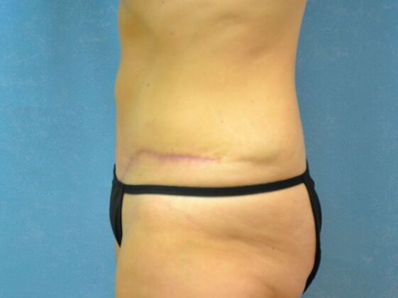 Tummy Tuck: Case 1811- Lyons, OH - After