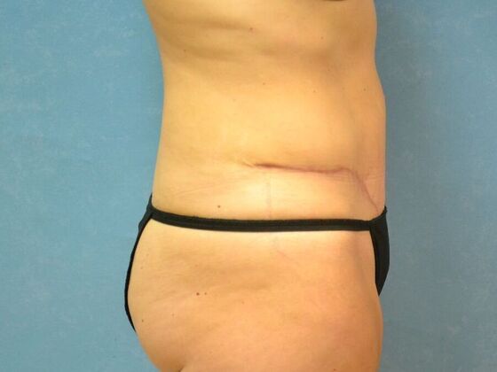 Tummy Tuck: Case 1811- Lyons, OH - After
