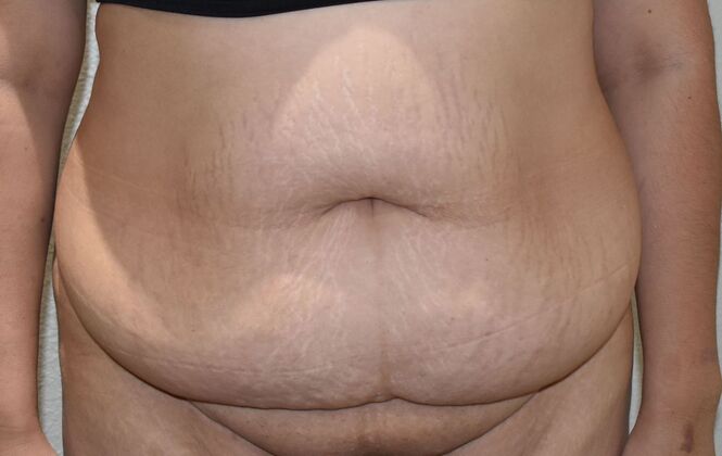 Tummy Tuck (Abdominoplasty): Case 421 - Before