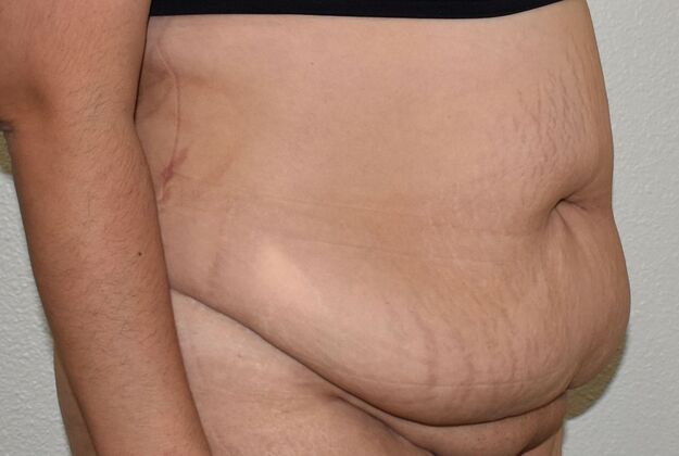 Tummy Tuck (Abdominoplasty): Case 421 - Before