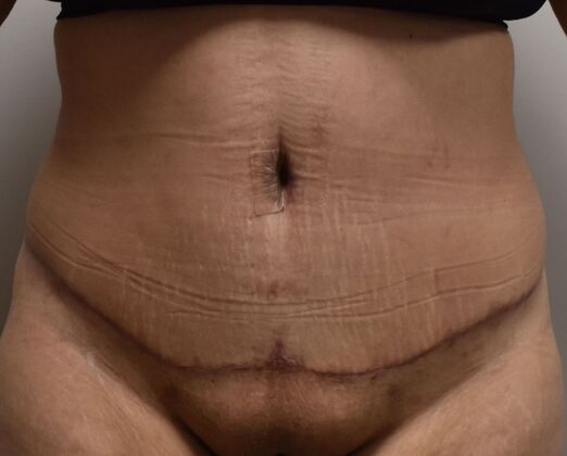 Tummy Tuck (Abdominoplasty): Case 421 - After