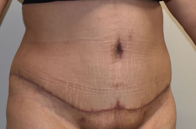 Tummy Tuck (Abdominoplasty): Case 421 - After