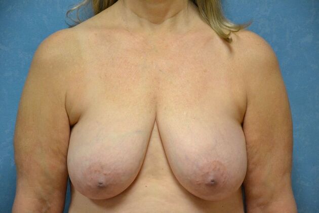 Breast Lift: Case 1449- Tiffin, OH - Before