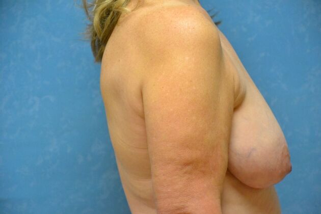 Breast Lift: Case 1449- Tiffin, OH - Before