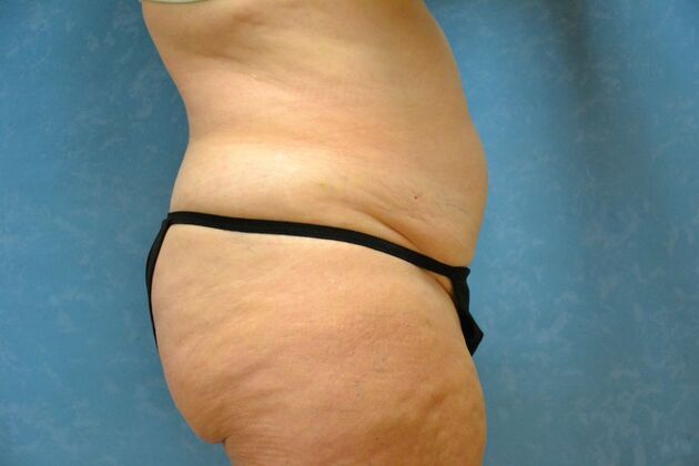 Tummy Tuck: Case 1802- Tiffin, OH - Before