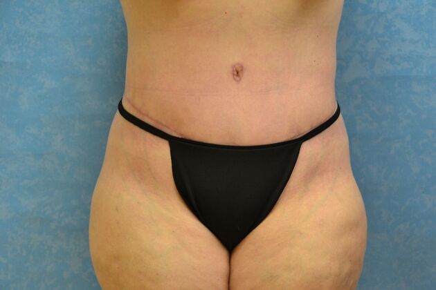 Tummy Tuck Case 1802- Tiffin, OH - After