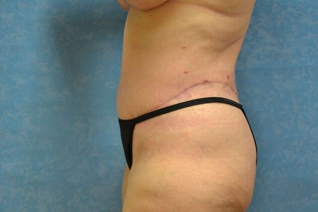 Tummy Tuck: Case 1802- Tiffin, OH - After