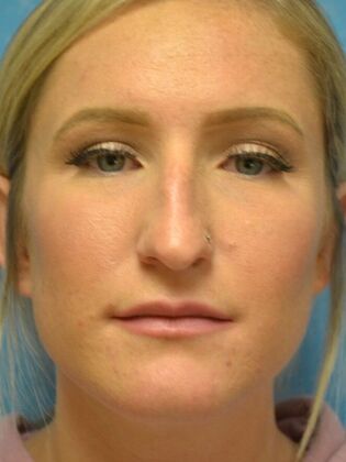 Rhinoplasty Case 1728- Port Clinton, OH - Before