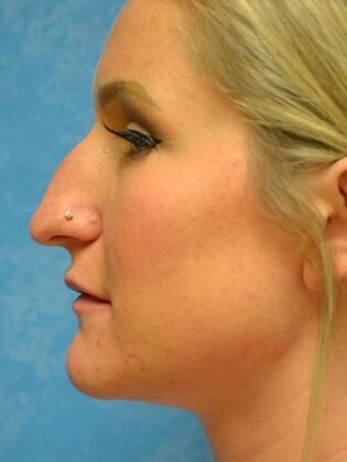 Rhinoplasty: Case 1728- Port Clinton, OH - Before