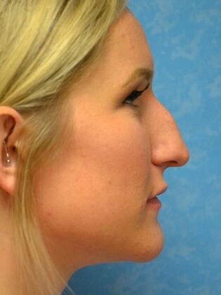 Rhinoplasty: Case 1728- Port Clinton, OH - Before