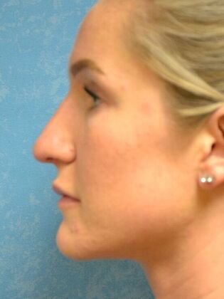 Rhinoplasty: Case 1728- Port Clinton, OH - After