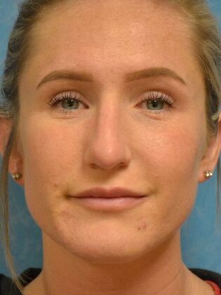 Rhinoplasty Case 1728- Port Clinton, OH - After