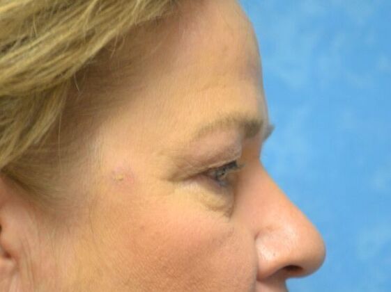 Eye Lift (Blepharoplasty): Case 1776- Fostoria, OH - Before