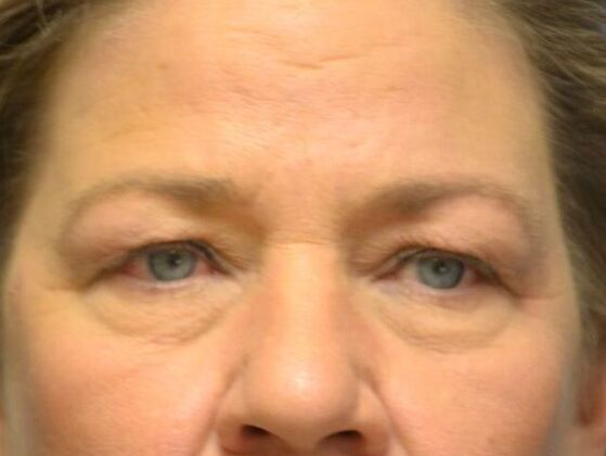 Eye Lift (Blepharoplasty) Case 1776- Fostoria, OH - Before