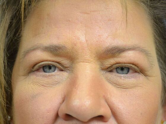 Eye Lift (Blepharoplasty) Case 1776- Fostoria, OH - After