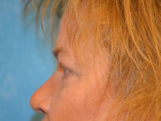 Eye Lift (Blepharoplasty): Case 1776- Fostoria, OH - After