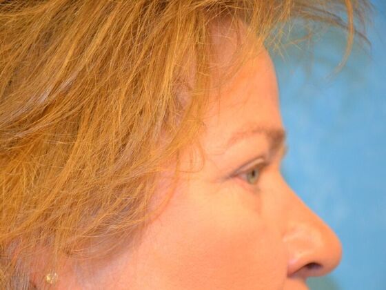 Eye Lift (Blepharoplasty): Case 1776- Fostoria, OH - After