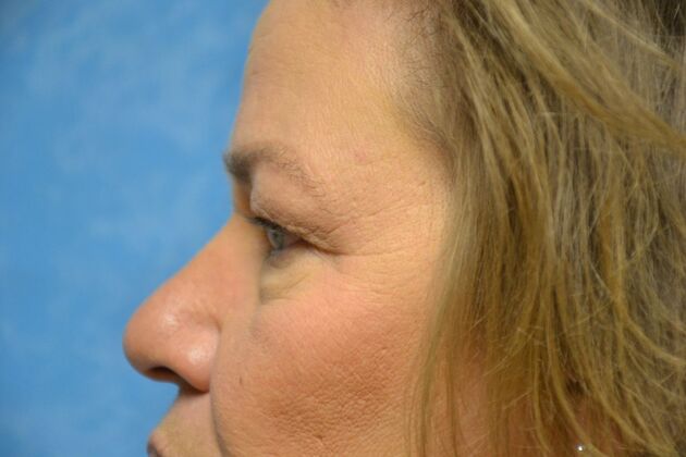 Eye Lift (Blepharoplasty): Case 1776- Fostoria, OH - Before
