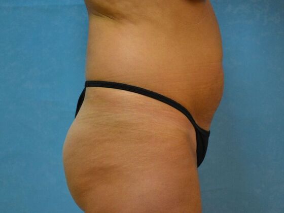 Tummy Tuck: Case 1776- Adrian, MI - Before