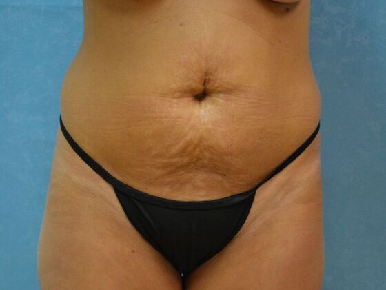 Tummy Tuck: Case 1776- Adrian, MI - Before