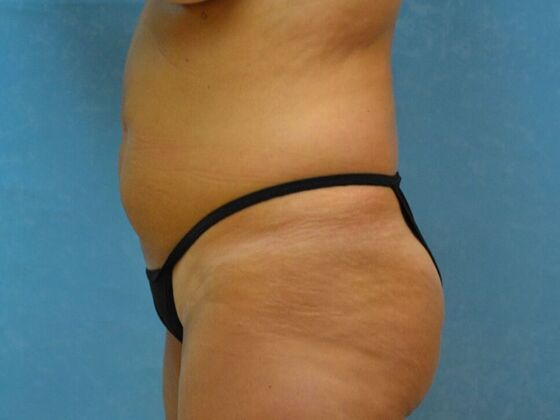 Tummy Tuck: Case 1776- Adrian, MI - Before