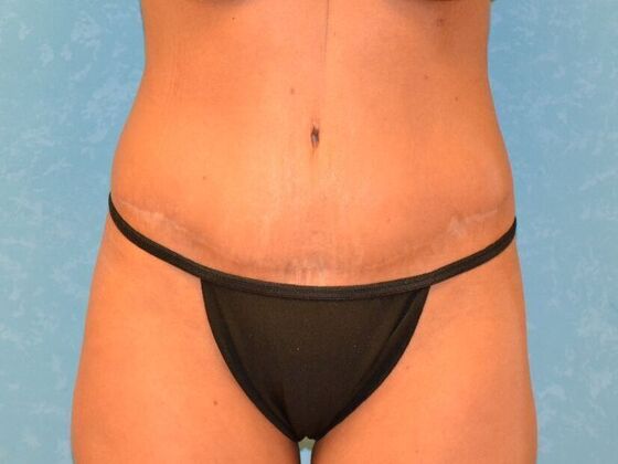 Tummy Tuck: Case 1776- Adrian, MI - After