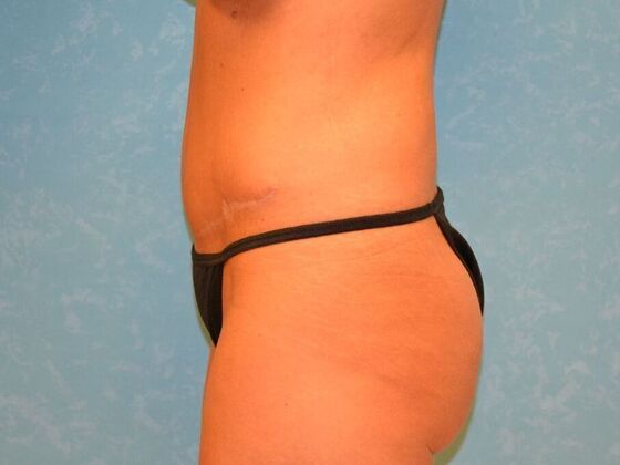 Tummy Tuck: Case 1776- Adrian, MI - After