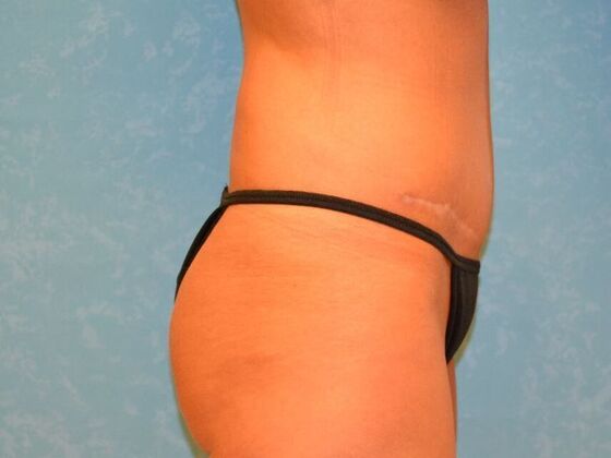 Tummy Tuck: Case 1776- Adrian, MI - After