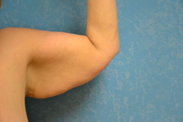 Arm Lift: Case 1509- Fremont, OH - Before