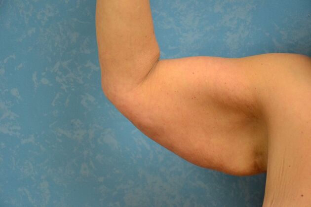 Arm Lift Case 1509- Fremont, OH - Before