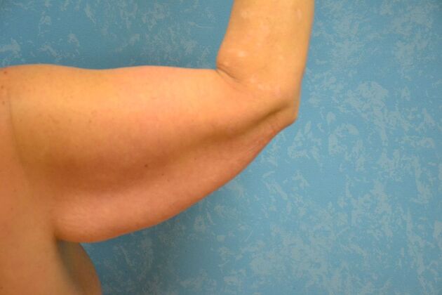 Arm Lift: Case 1509- Fremont, OH - Before