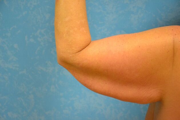 Arm Lift: Case 1509- Fremont, OH - Before