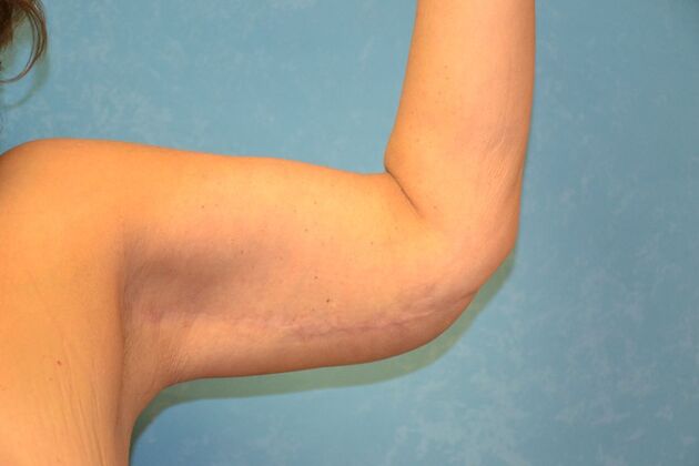 Arm Lift: Case 1509- Fremont, OH - After