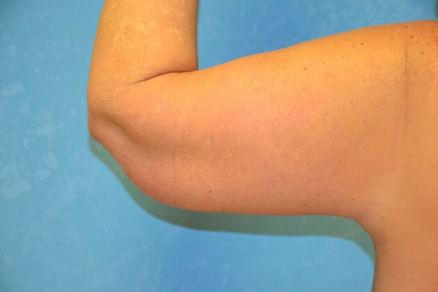 Arm Lift: Case 1509- Fremont, OH - After