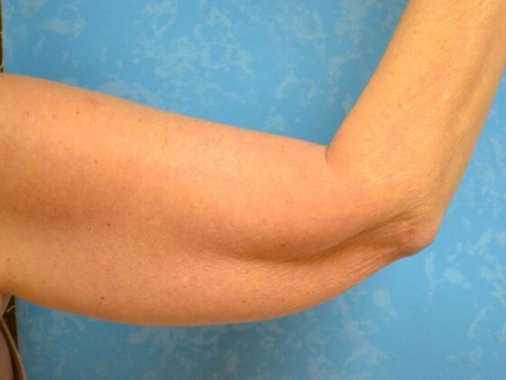 Arm Lift: Case 1508- Sylvania, OH - Before