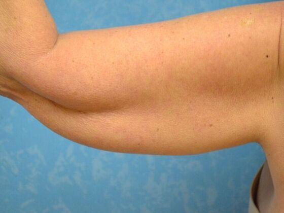 Arm Lift Case 1508- Sylvania, OH - Before