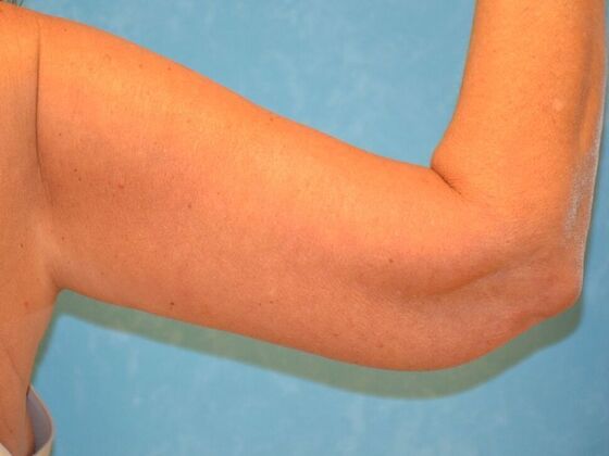 Arm Lift: Case 1508- Sylvania, OH - After