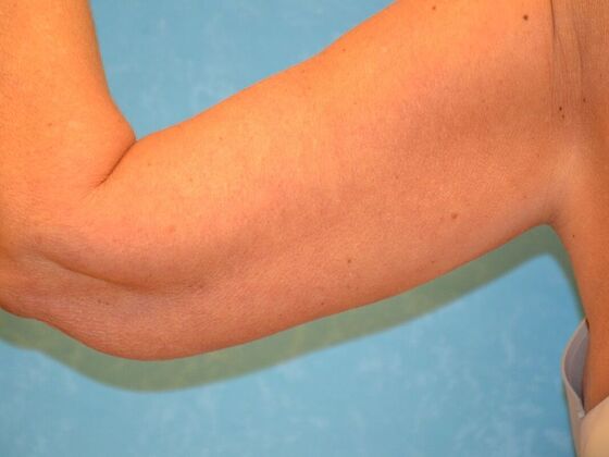 Arm Lift Case 1508- Sylvania, OH - After