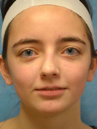 Rhinoplasty Case 1726- Bowling Green, OH - Before