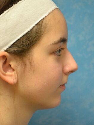 Rhinoplasty: Case 1726- Bowling Green, OH - Before