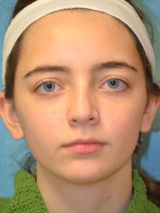 Rhinoplasty Case 1726- Bowling Green, OH - After