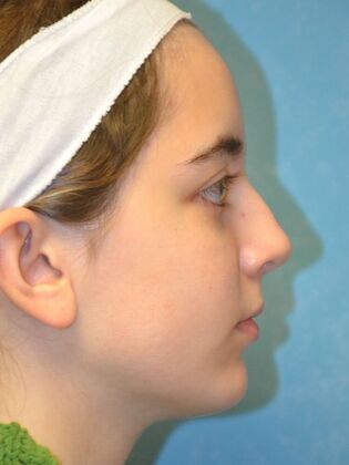 Rhinoplasty: Case 1726- Bowling Green, OH - After