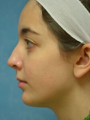 Rhinoplasty: Case 1726- Bowling Green, OH - After