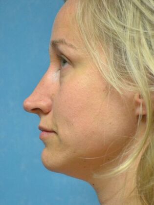 Rhinoplasty: Case 1729- Waterville, OH - After