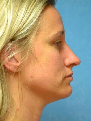 Rhinoplasty Case 1729- Waterville, OH - After
