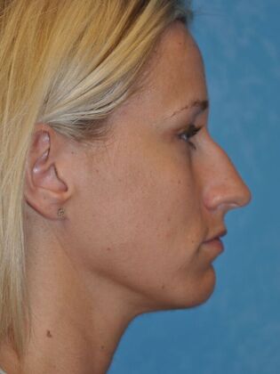 Rhinoplasty Case 1729- Waterville, OH - Before