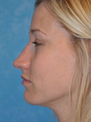 Rhinoplasty: Case 1729- Waterville, OH - Before