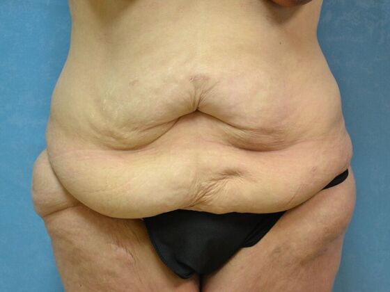 Bodylift Case 1619- Edgerton, OH - Before