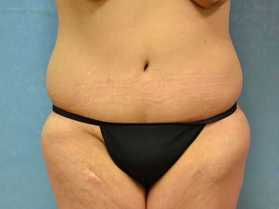 Bodylift Case 1619- Edgerton, OH - After